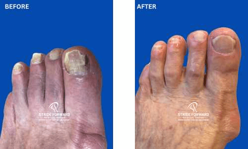 before and after nail infection