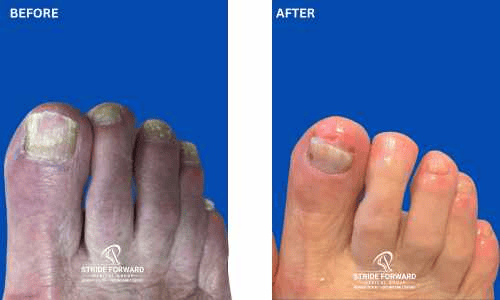 before and after nail infection