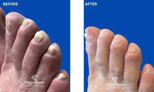 before and after nail infection