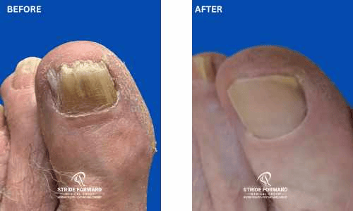 before and after nail infection
