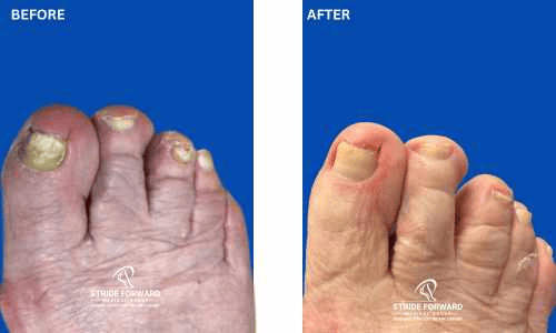 before and after nail infection