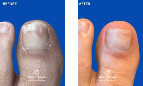 before and after nail infection