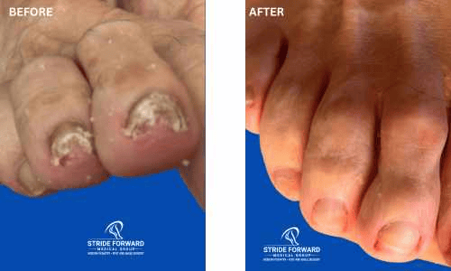 before and after nail infection