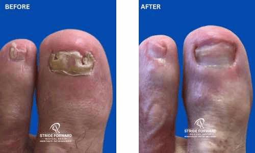 before and after nail infection