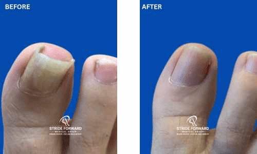 before and after nail infection