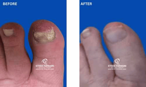 before and after nail infection