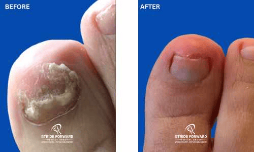 before and after nail infection
