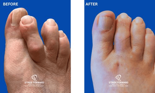 BEFORE & AFTER crossover hammertoe