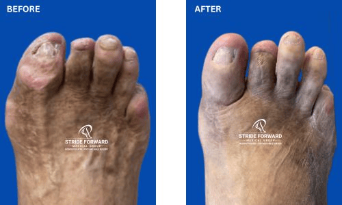 revision bunion in diabetic patient before and after
