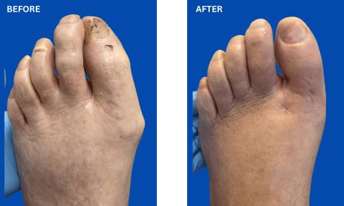 bunion and long hammertoe before and after