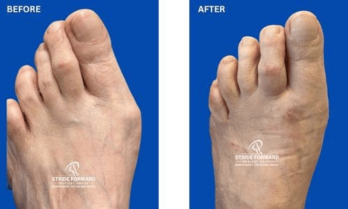 Before and after bunion and hammertoe surgery showing improved great toe and lesser toe alignment