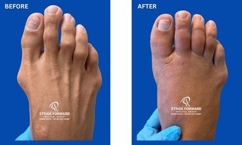 Before and after bunion and hammertoe surgery showing improved great toe and lesser toe alignment