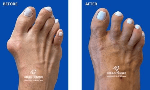 Before and after bunion and hammertoe surgery showing improved great toe and lesser toe alignment