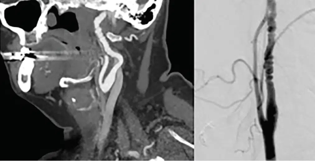 Fibromuscular Dysplasia