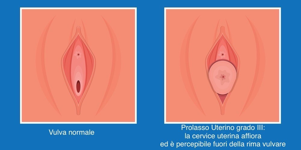 uno dei sintomi del prolasso uterino è la percezione della cervice a livello vulvare