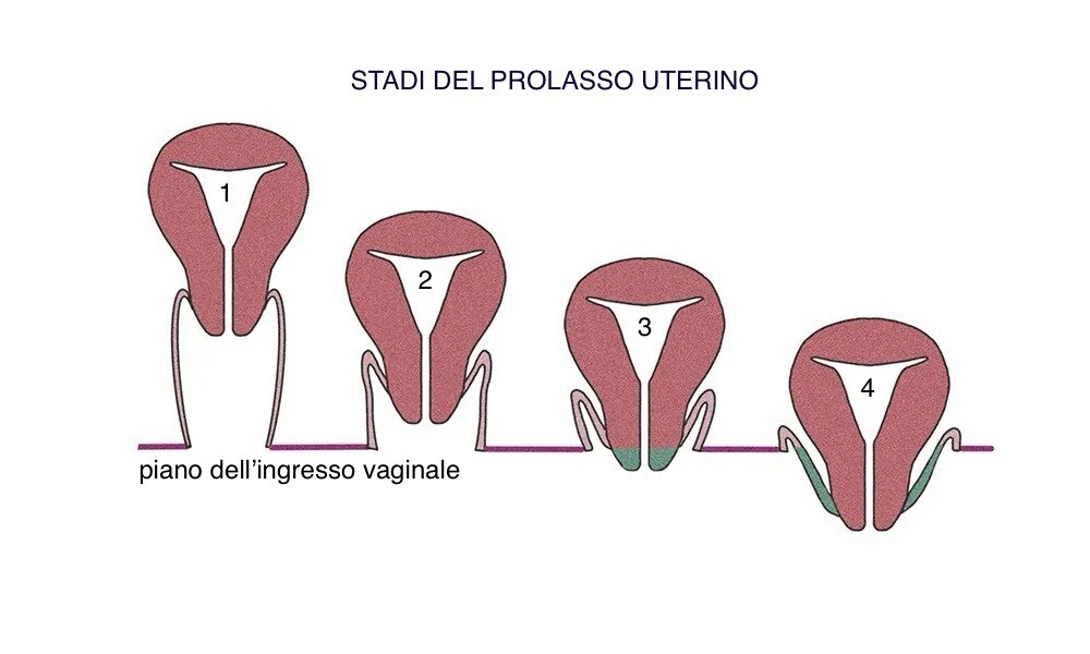 un grafico che illustra i 4 stadi del prolasso uterino