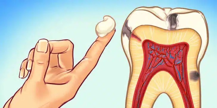Toothache: Symptoms, Causes, Prevention, Treatment and Home Remedies.