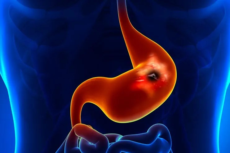 Stomach Ulcer 