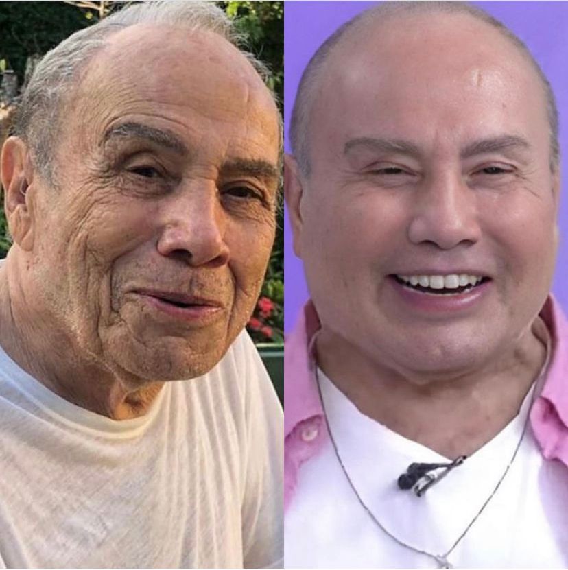 Harmonização facial de Stenio Garcia gera debate sobre limites de idade e quantidade de material aplicado