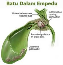Apa Dan Bagaimana Batu Kandung Empedu 