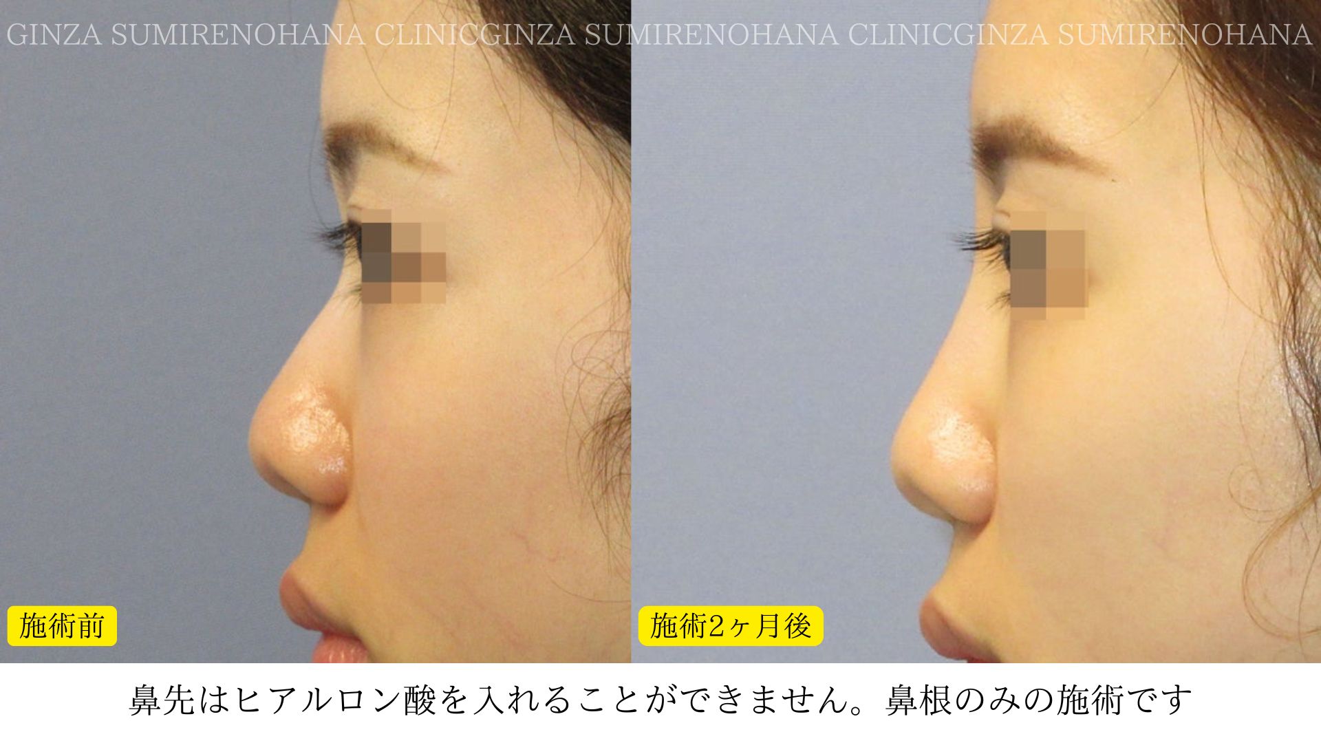 ヒアルロン酸注入について | 銀座すみれの花クリニックの手術