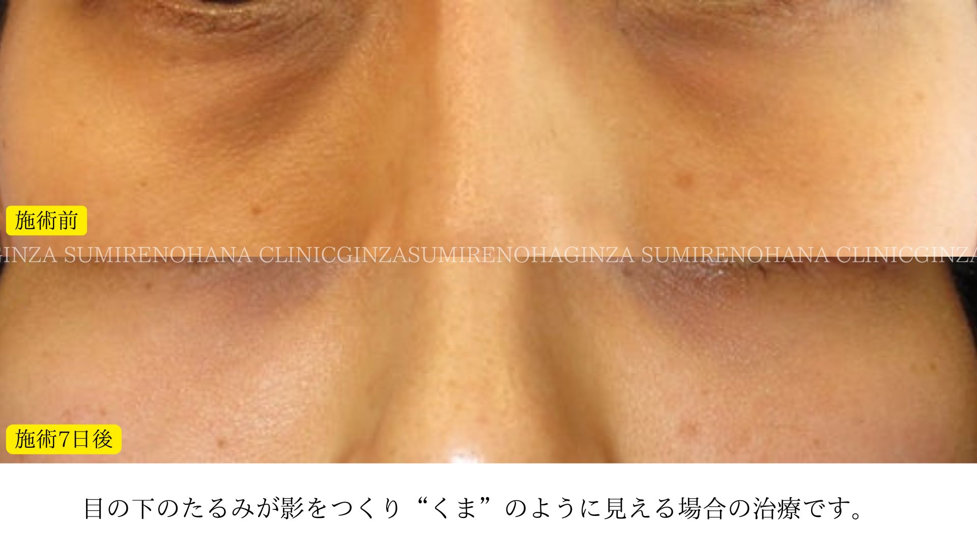 ヒアルロン酸注入について | 銀座すみれの花クリニックの手術