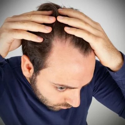 Does Creatine Cause Hair Loss: 5 Facts That Will Shock You! + In-Depth Analysis 5 Man Showing Receding Hairline - Anticipating it's Hair Loss because of Creatine