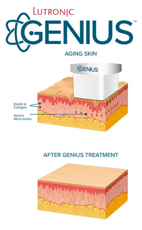 Diagram of Lutronic Genius RF microneedling — insulated microneedles delivering radiofrequency energy into the dermis to stimulate elastin and collagen, shown before and after treatment.