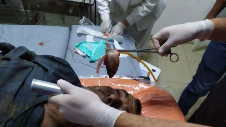رجل ينجو بأعجوبة من الاختناق .. جراء سمكة حية في مجرى التنفس