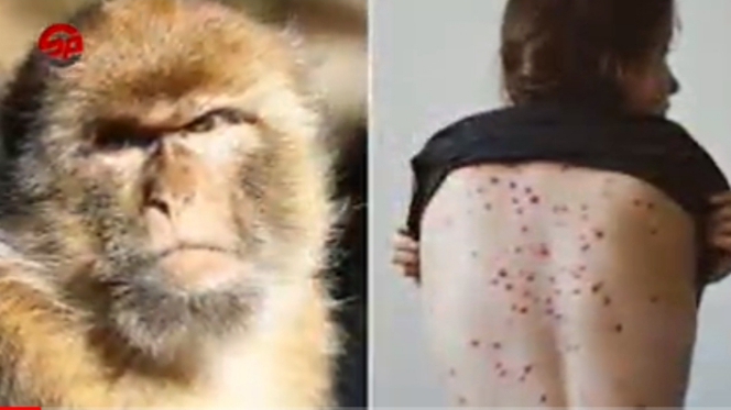 جدري القرود