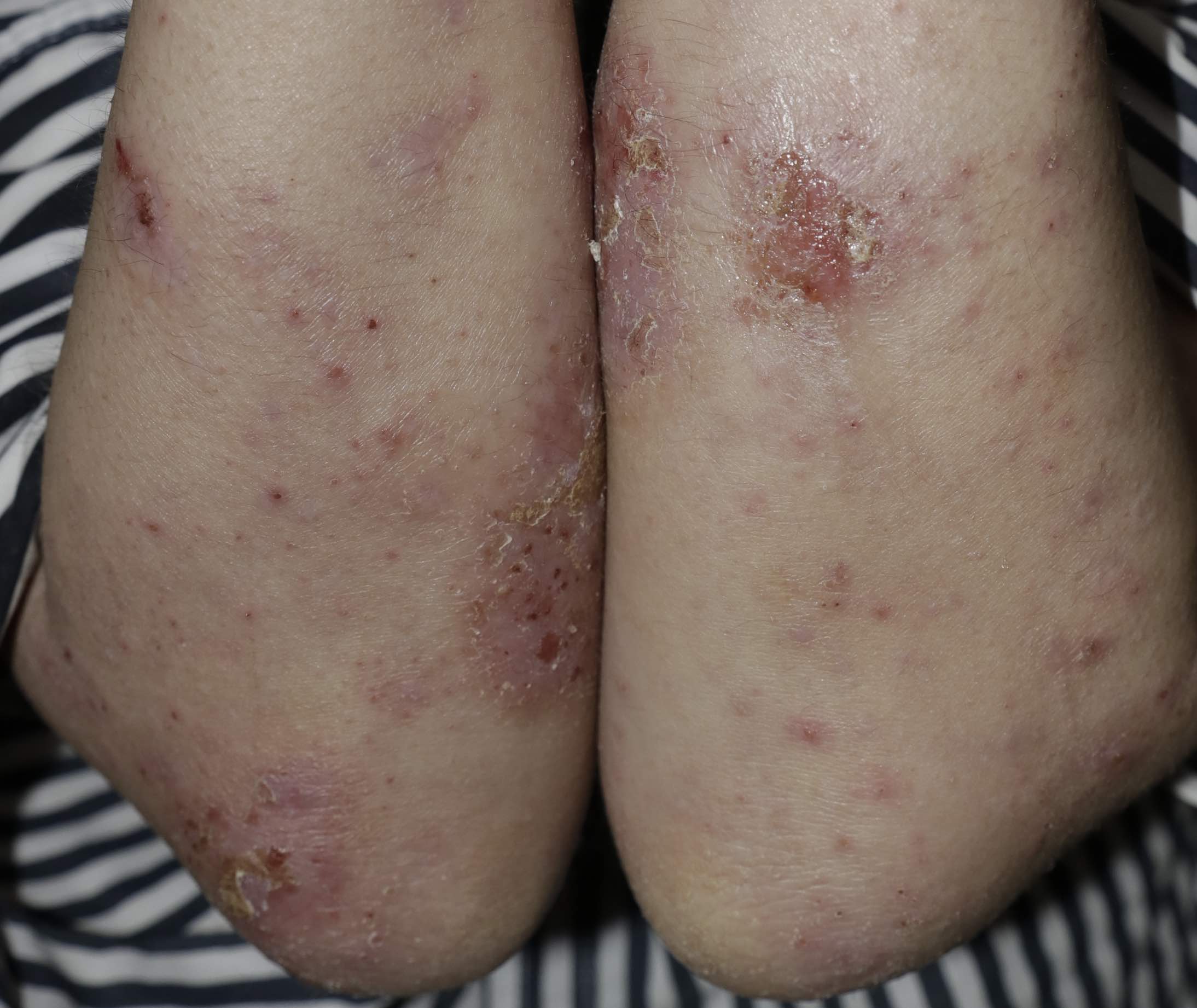 Management of Vaccine-Induced Eczema Flare-Up with Herbal