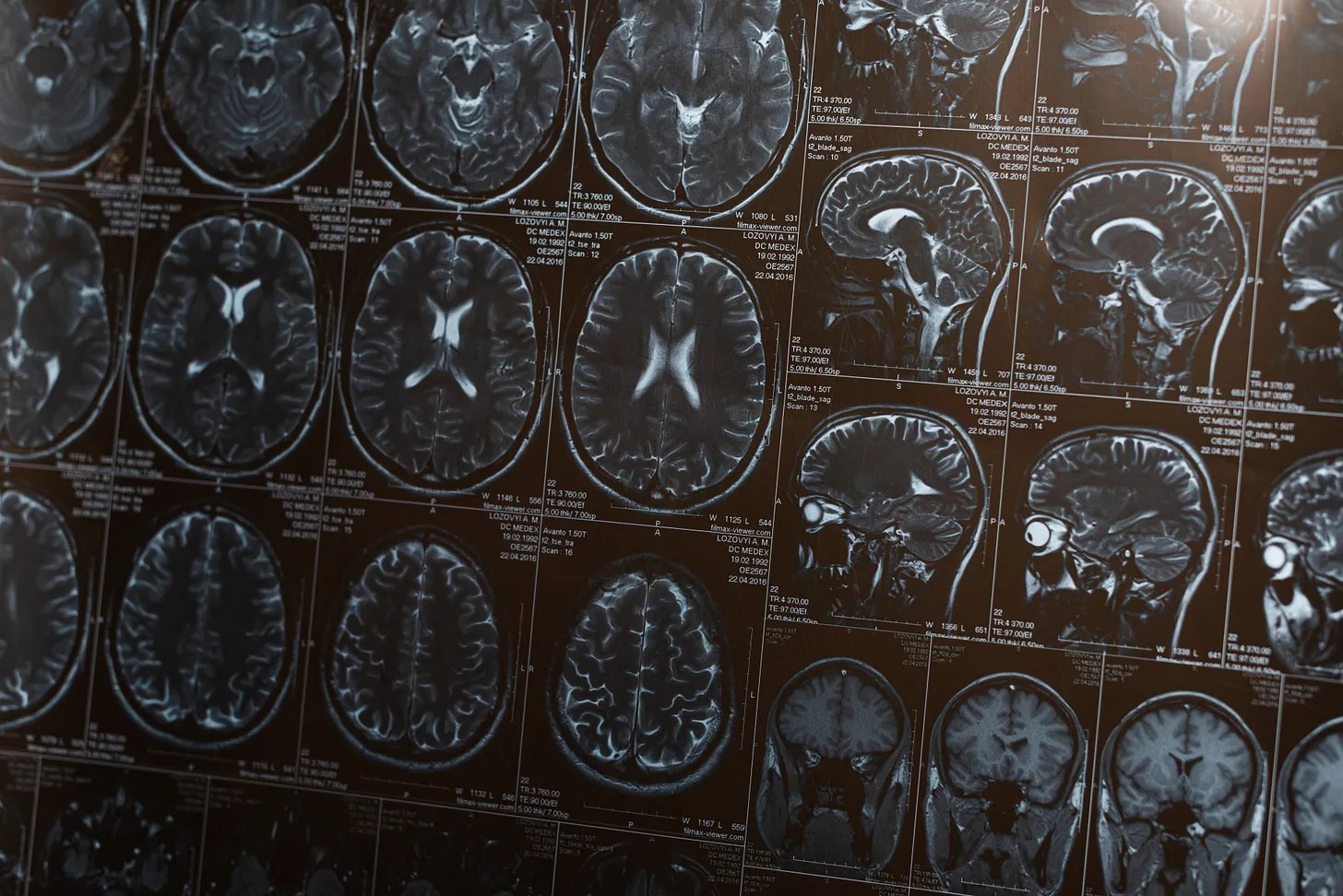 Brain scan MRI