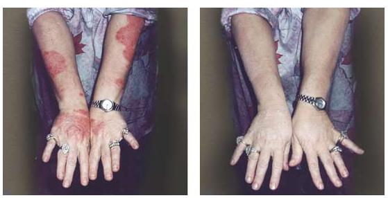 Regret Your Tattoo We Can Remove Or Cover That Tattoo For You