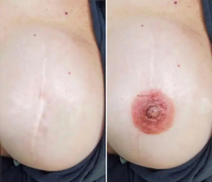 Breast scar camouflage service