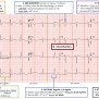 How To Read An ECG - TeachIM