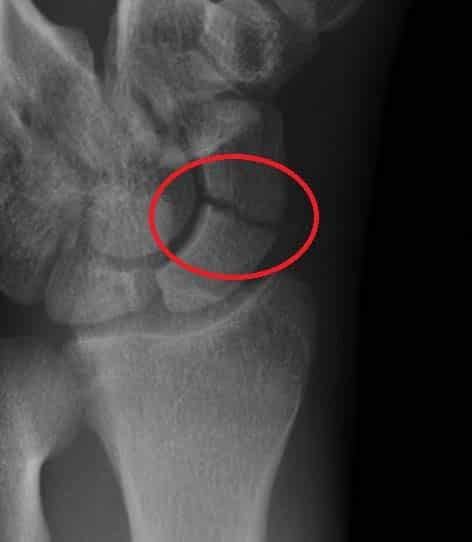 The hand has eight carpals. The Wrist Joint Teachmeanatomy