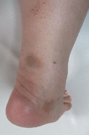 色素性紫斑性皮膚病腿上小紅點 色素性紫斑癥 Dykpo