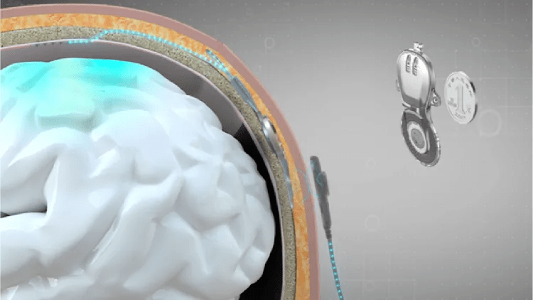 China leads the world in invasive BCI products