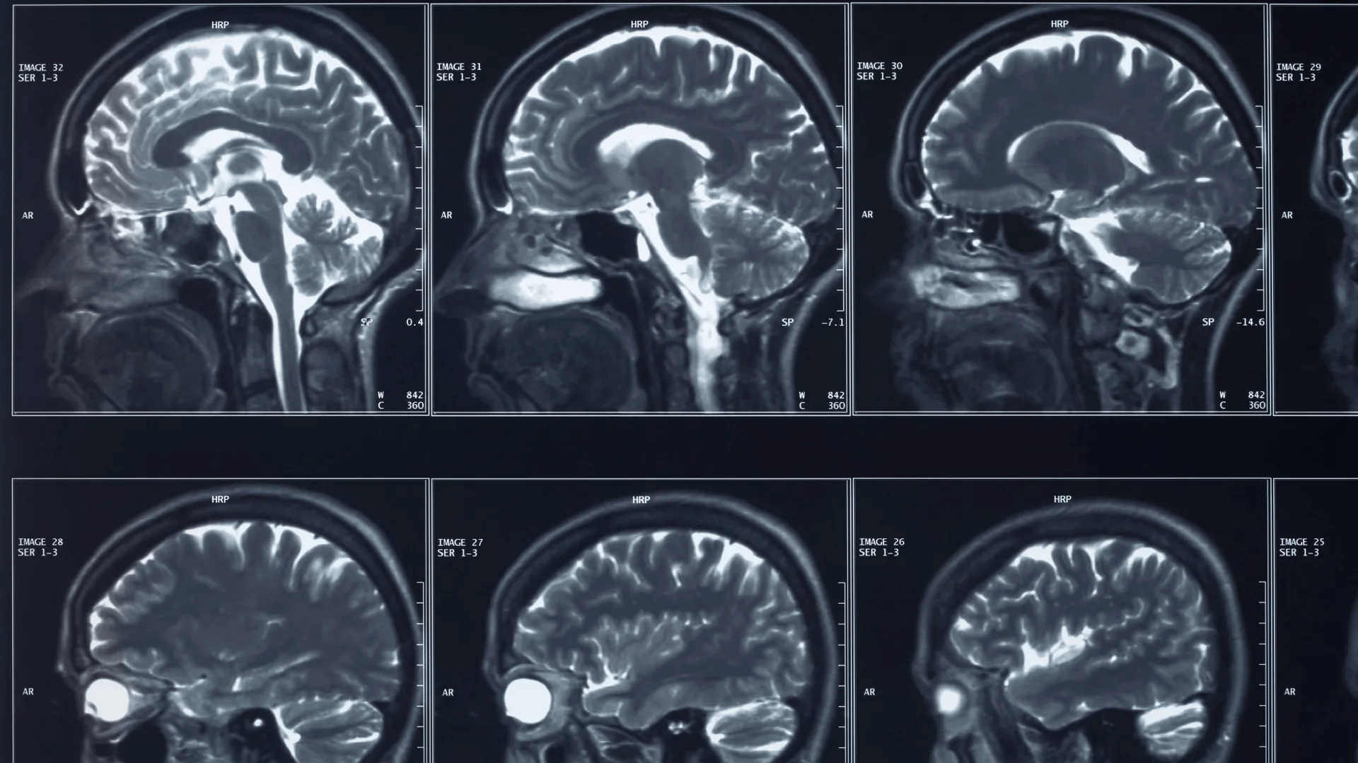 A brain implant to treat depression gets FDA greenlight to start trials