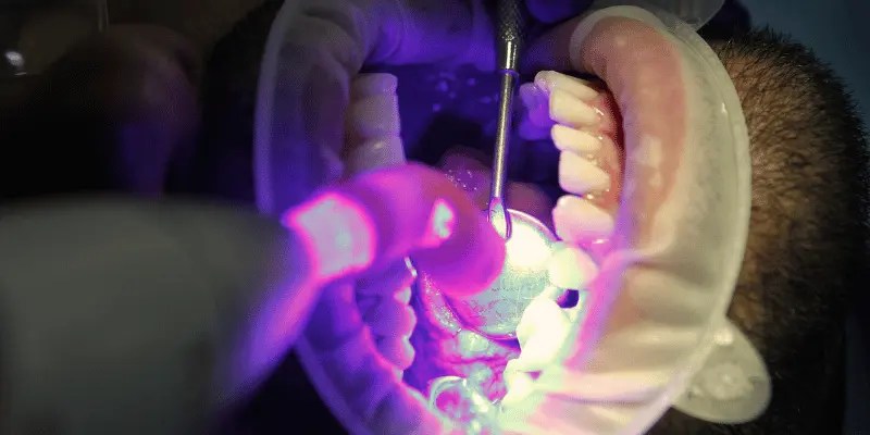 Day 3 after immediate dentures