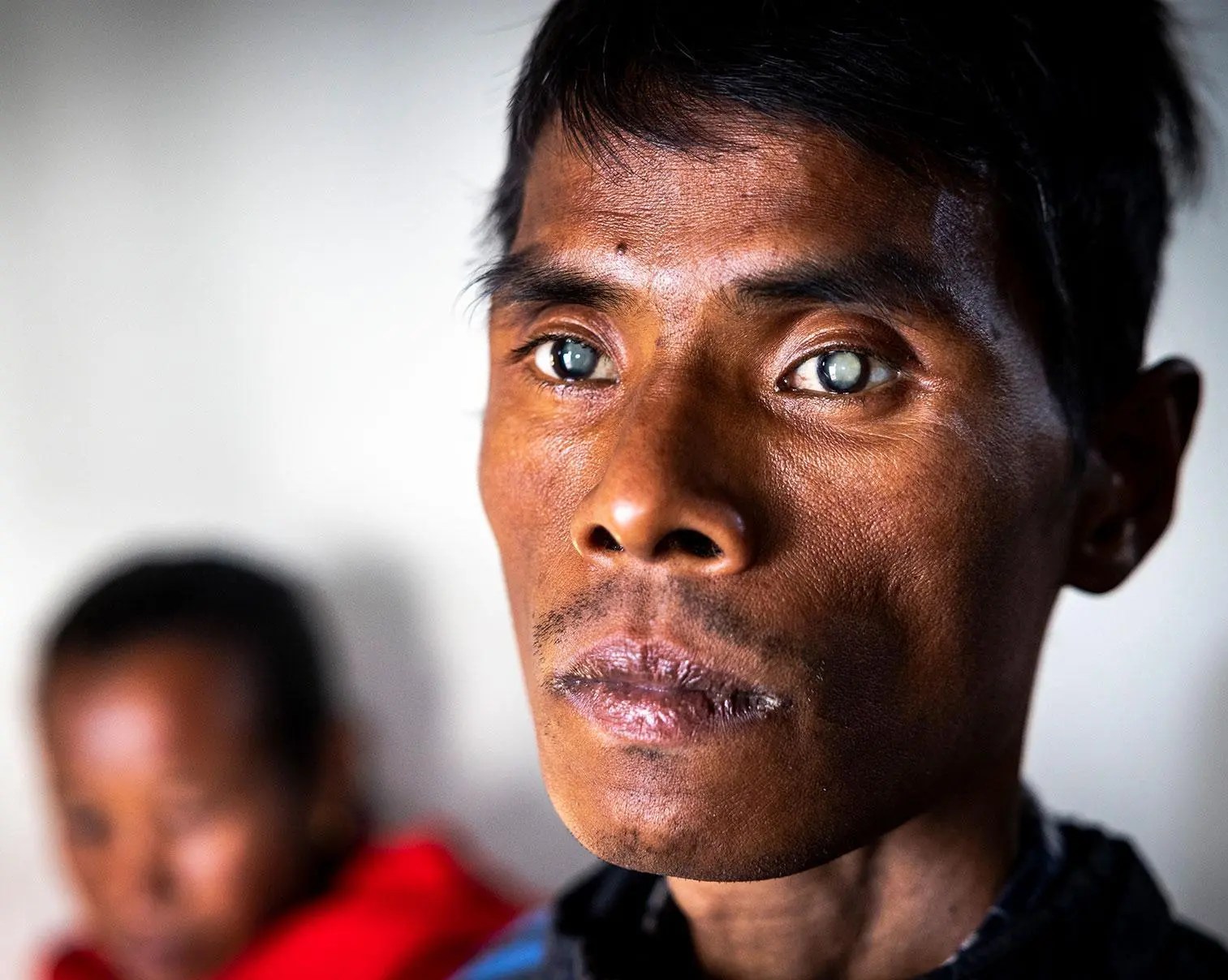 Man's cataract in both eyes by TKRF