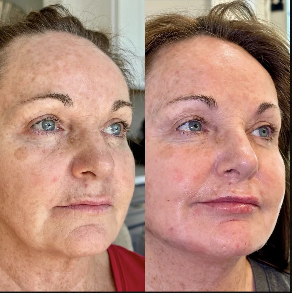 Full Face Filler before and after