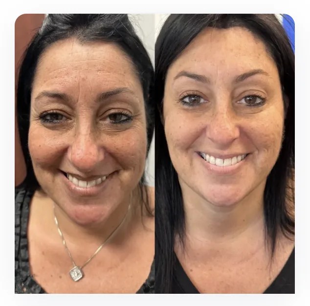 Full Face Botox before and after