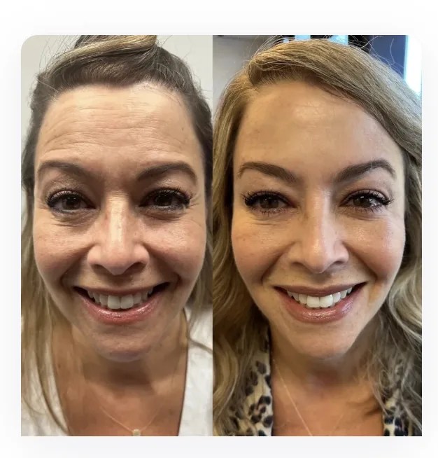 Forehead and Crow's Feet before and after