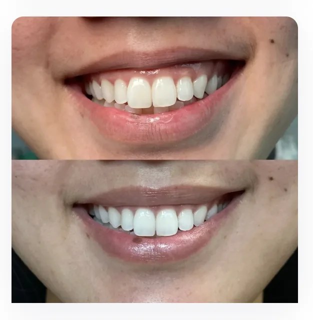 Gummy Smile before and after