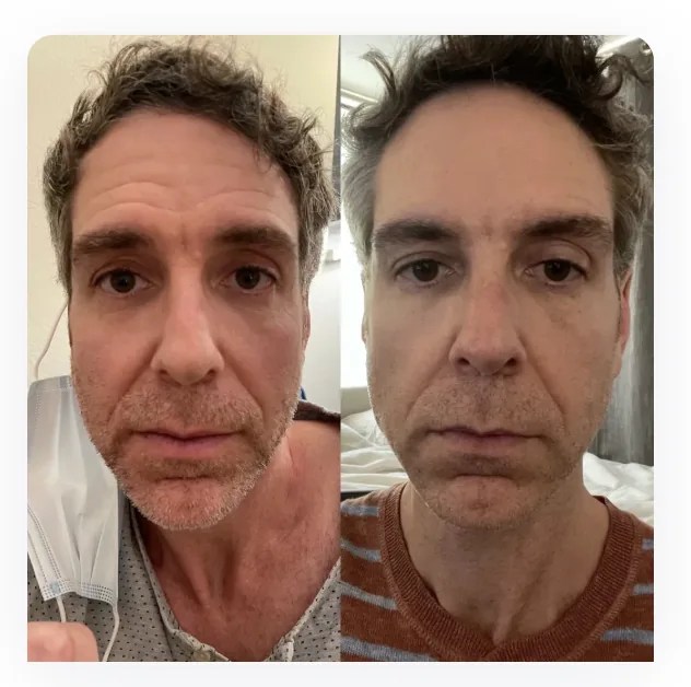 Full Face Botox before and after