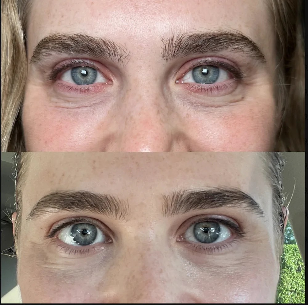 Brow Lift Botox before and after