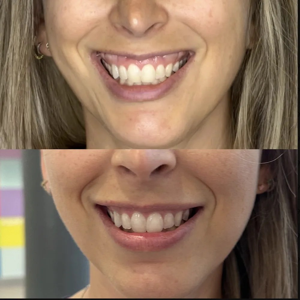 Gummy Smile before and after