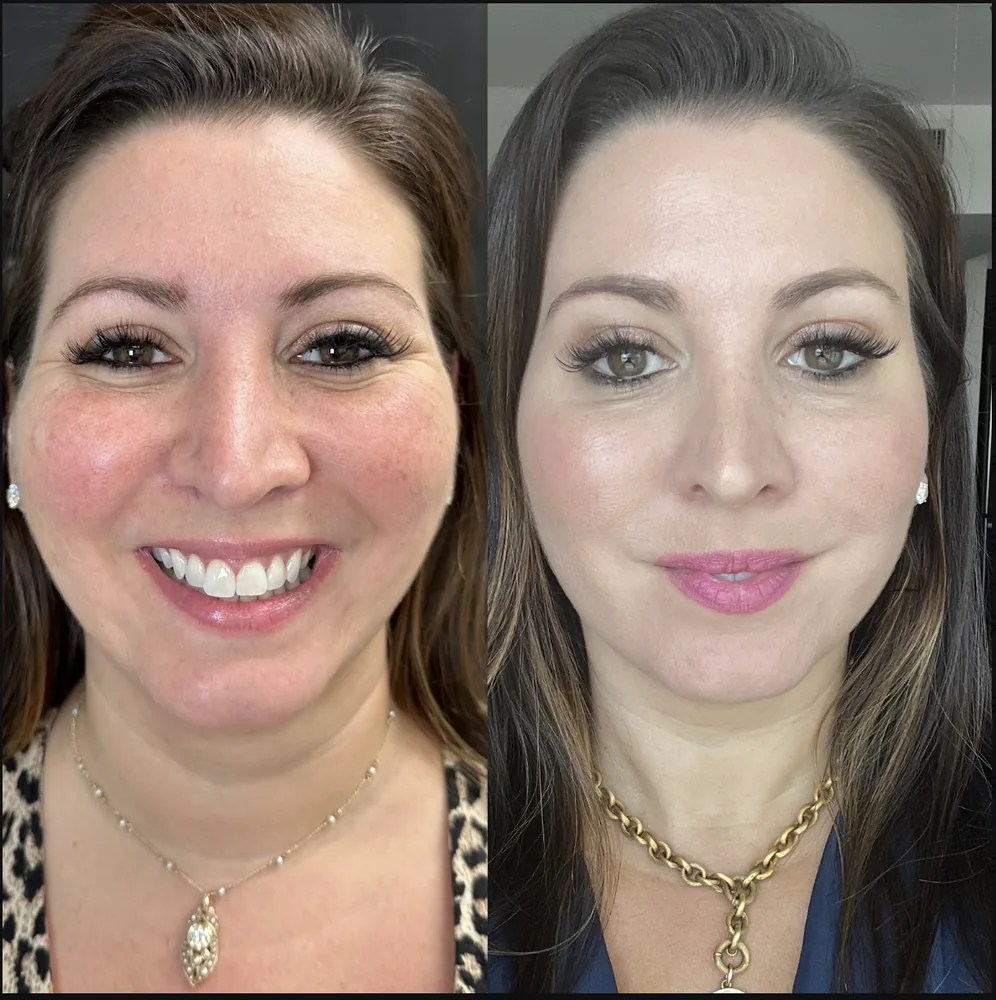 Full Face Botox before and after