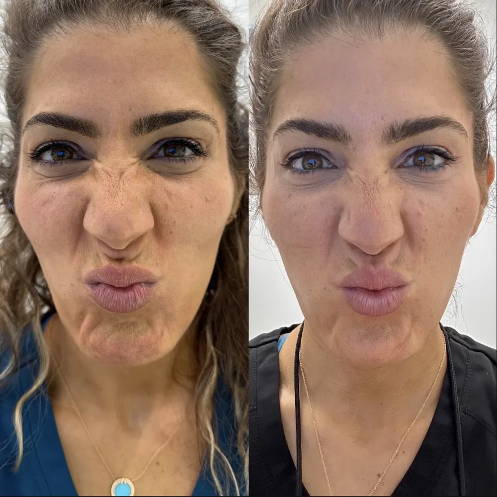 Lip Flip before and after